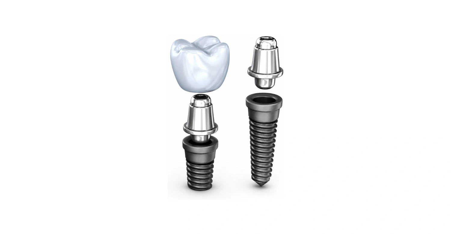 Are All Dental Implants Titanium